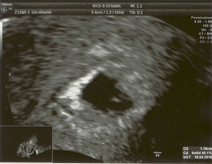 Ultraschall Foto Schwangerschaft 6w0d