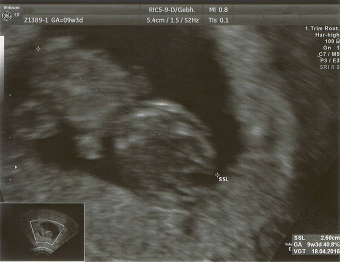 Ultraschall Foto Schwangerschaft 9w3d