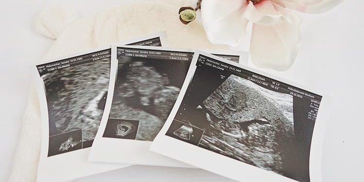 Von der "Bohne" bis zum Baby - die ersten Ultraschallbilder