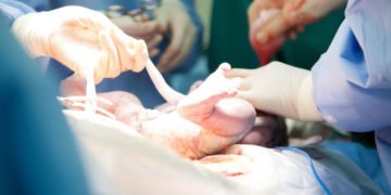 Die Nabelschnur auspulsieren lassen